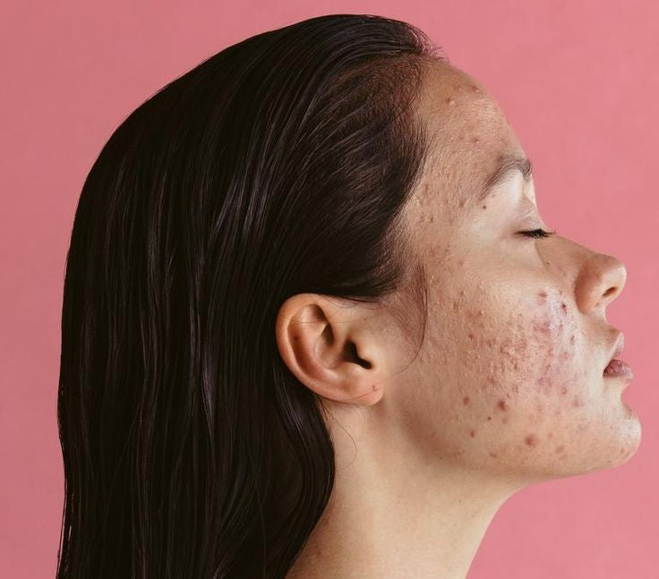 Controle de acne